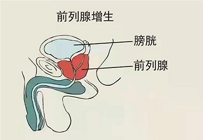 深圳治療前列腺增生醫院哪家好？怎麼預防？1