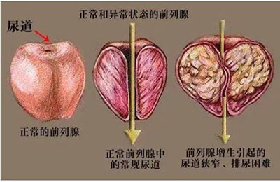 深圳治療前列腺增生醫院哪家好？怎麼預防？2