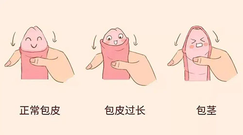 包皮包莖多大年齡做手術合適，一共要花多少錢1