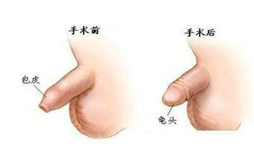 包皮包莖多大年齡做手術合適，一共要花多少錢2